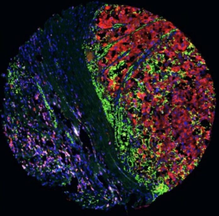 Imagen de inmunofluorescencia de una muestra de melanoma humano en la que se observan proteínas marcadas en diferentes colores implicadas en la metástasis y la resistencia a la inmunoterapia. Fotografía facilitada por el Centro Nacional de Biotecnología (CNB-CSIC).
